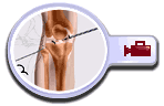 Knee Arthroscopy, Auckland New Zealand